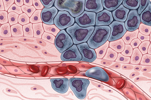  Growing cancer cells (in purple) are surrounded by healthy cells (in pink), illustrating a primary tumor spreading to other parts of the body through the circulatory system. Image credit: Darryl Leja, NHGRI.]
