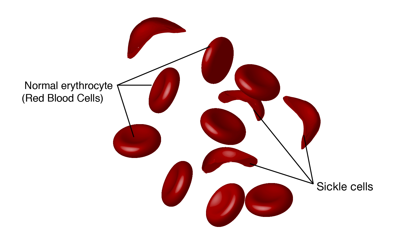 sickle cell anemia inheritance